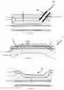 Fig. 04 - CRYOLIPOLYSIS DEVICES AND METHODS THEREFOR