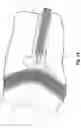 Fig. 15 - Respiratory mask system
