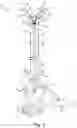 Fig. 02 - Bi-lateral catheter system and methods for use