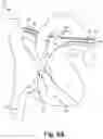 Fig. 08 - Bi-lateral catheter system and methods for use