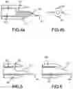 Fig. 04 - IV catheter with vein entry indication