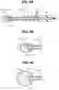 Fig. 04 - BALLOON CATHETER SYSTEM AND METHOD FOR OPTICAL TUMOR TREATMENT