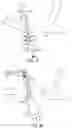 Fig. 20 - System and method for treating pulmonary edema