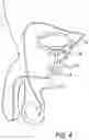 Fig. 05 - URETHRAL DEVICE