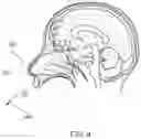 Fig. 06 - METHOD FOR INTRANASAL STEM CELL THERAPY