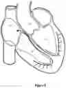 Fig. 02 - Intraseptal multi-electrode cardiac pacemaker and methods of use thereof