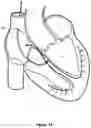 Fig. 09 - Intraseptal multi-electrode cardiac pacemaker and methods of use thereof