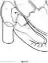 Fig. 10 - Intraseptal multi-electrode cardiac pacemaker and methods of use thereof