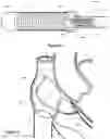 Fig. 11 - Intraseptal multi-electrode cardiac pacemaker and methods of use thereof