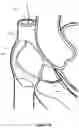 Fig. 12 - Intraseptal multi-electrode cardiac pacemaker and methods of use thereof