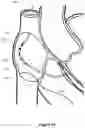 Fig. 13 - Intraseptal multi-electrode cardiac pacemaker and methods of use thereof