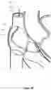 Fig. 14 - Intraseptal multi-electrode cardiac pacemaker and methods of use thereof