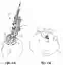 Fig. 02 - Medical device anchoring