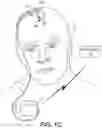 Fig. 03 - Medical device anchoring