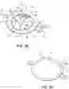 Fig. 05 - Medical device anchoring