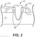 Fig. 06 - Medical device anchoring