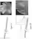 Fig. 04 - Biomedical device comprising a mechanically adaptive member