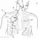 Fig. 01 - Percutaneous access for systems and methods of treating sleep-related disordered breathing
