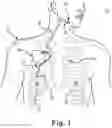 Fig. 02 - Percutaneous access for systems and methods of treating sleep-related disordered breathing