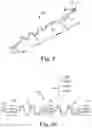 Fig. 11 - Percutaneous access for systems and methods of treating sleep-related disordered breathing