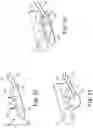 Fig. 17 - Percutaneous access for systems and methods of treating sleep-related disordered breathing