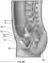 Fig. 04 - System and Method For Electrical Stimulation of Anorectal Structures To Treat Urinary Dysfunction