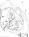 Fig. 01 - AV SYNCHRONOUS VFA CARDIAC THERAPY