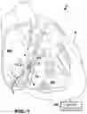 Fig. 02 - AV SYNCHRONOUS VFA CARDIAC THERAPY