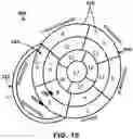 Fig. 16 - AV SYNCHRONOUS VFA CARDIAC THERAPY