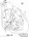 Fig. 17 - AV SYNCHRONOUS VFA CARDIAC THERAPY