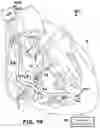Fig. 19 - AV SYNCHRONOUS VFA CARDIAC THERAPY
