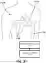 Fig. 22 - AV SYNCHRONOUS VFA CARDIAC THERAPY