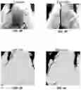 Fig. 06 - A couch-mounted stereoscopic surface imaging and biofeedback system