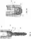 Fig. 09 - Poly-axial implant fixation system