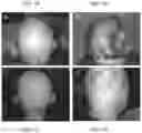 Fig. 108 - Methods for treating hair loss disorders