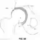 Fig. 46 - Orthopedic implants having gradient polymer alloys