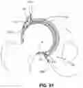 Fig. 47 - Orthopedic implants having gradient polymer alloys