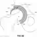 Fig. 48 - Orthopedic implants having gradient polymer alloys