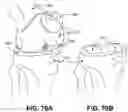 Fig. 55 - Orthopedic implants having gradient polymer alloys