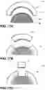 Fig. 56 - Orthopedic implants having gradient polymer alloys