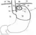 Fig. 01 - Apparatus and method for treating obesity