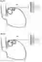 Fig. 06 - Apparatus and method for treating obesity