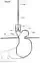 Fig. 19 - Apparatus and method for treating obesity