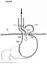 Fig. 22 - Apparatus and method for treating obesity