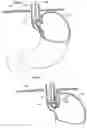 Fig. 23 - Apparatus and method for treating obesity