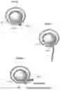 Fig. 25 - Apparatus and method for treating obesity