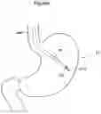 Fig. 28 - Apparatus and method for treating obesity
