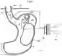 Fig. 33 - Apparatus and method for treating obesity