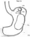 Fig. 34 - Apparatus and method for treating obesity