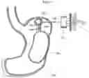 Fig. 35 - Apparatus and method for treating obesity